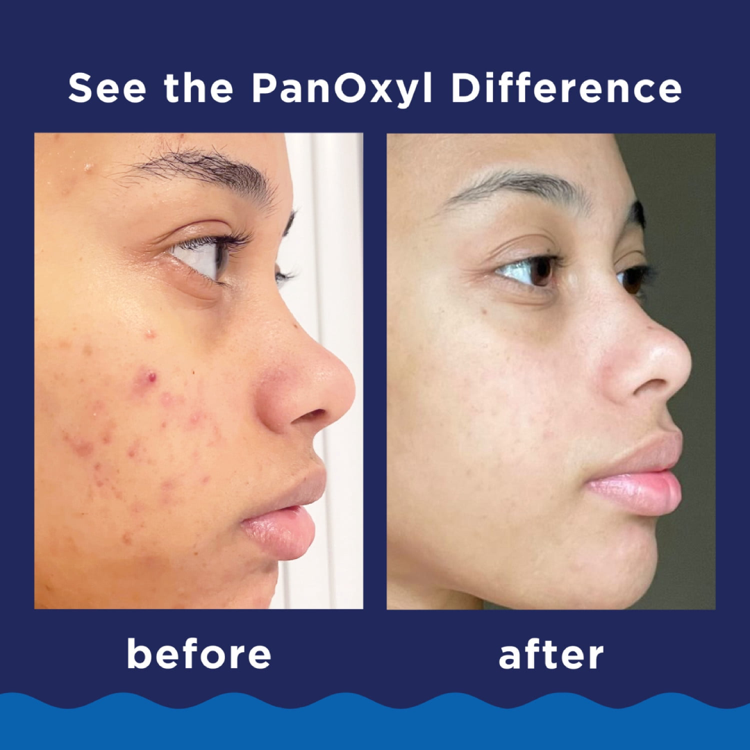 PanOxyl 10% Benzoyl Peroxide Acne Foaming Wash | Maximum Strength Acne Cleanser 5.5 Oz PanOxyl